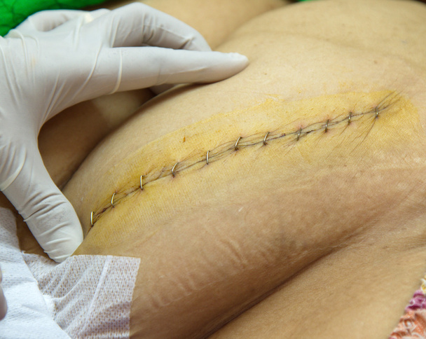 sutura moderna
 - Foto, immagini