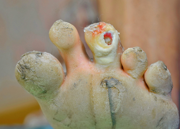 diabetic foot wound - Photo, Image