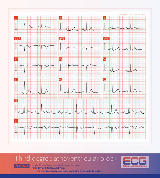 Third degree atrioventricular block in young women may be congenital, with the block located on the atrioventricular node or above bifurcation of the His bundle. - Photo, Image