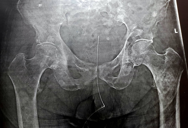 Hoge waarschijnlijkheid van subtrochanterische, trochanterische scheurfractuur en maligniteitmetastase in de mediale zijde van de bovendijschacht van een oude patiënt met prostaatkanker met urinekatheter - Foto, afbeelding