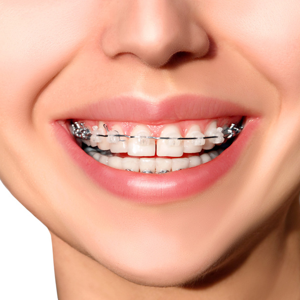 Closeup keramiek en metaal tussen accolades op tanden. Brede glimlach met zelf ligating haken. - Foto, afbeelding