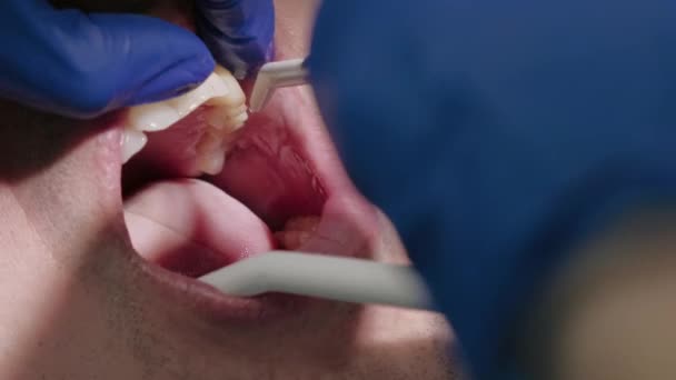 Primer plano video de cuidado de dientes, estomatólogo limpieza de dientes. - Imágenes, Vídeo