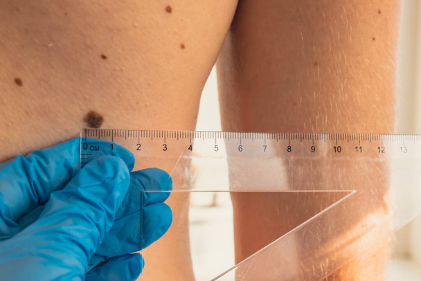 Dermatologist checking sizes of male birthmarks with ruler. Doctor examining length and width of benign moles on man skin Pigmentation.  - Photo, Image