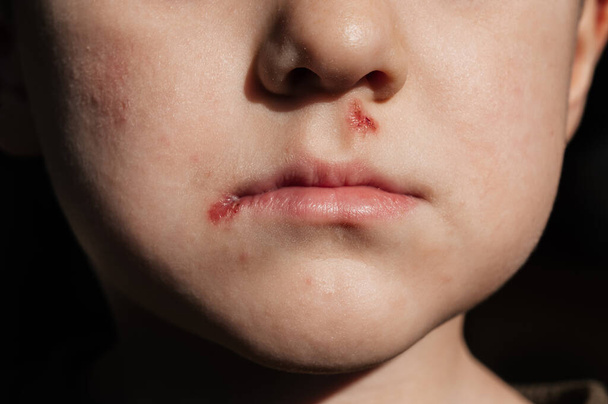 Yüzünde yaralar olan bir çocuk. Burnun altında ve dudağında kabuk olan bir ülser. Dermatolojik deri hastalığı. Yakın plan. - Fotoğraf, Görsel