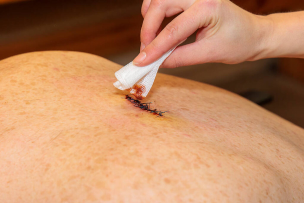 Een hand reinigt een dubbel gehecht litteken van een abces operatie op een rug met jodium en een wattenstaafje - Foto, afbeelding
