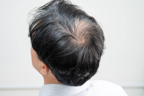 Bald in the middle head and begin no loss hair glabrous of mature Asian business smart active office man. - 写真・画像