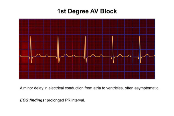 3D illustratie van een ECG met 1ste graads AV blok, een hartgeleidingsstoornis. - Foto, afbeelding