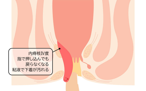 Diseases of the anus, hemorrhoids and warts "Internal hemorrhoids, degree IV" Illustration, cross-sectional view - Translation: Internal hemorrhoids, degree IV, Cannot be pushed back in with fingers, mucus stains underwear - Wektor, obraz