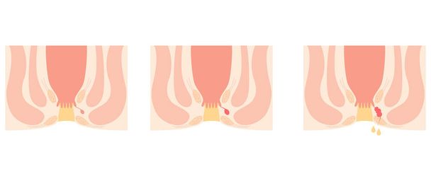 Diseases of the anus, hemorrhoids "Anorectal hemorrhoids" Illustration, cross-sectional view, Vector Illustration - Vector, Image