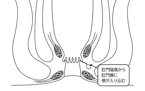 Diseases of the anus, hemorrhoids "Anorectal hemorrhoids" Illustration, cross-sectional view - Translation: Stool enters through the perineal fossa - Vector, Image