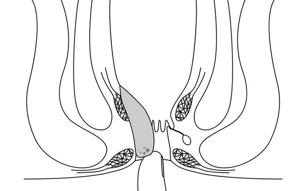 Diseases of the anus, hemorrhoids and warts "Internal hemorrhoids, degree III" Illustration, cross-sectional view, Vector Illustration - Vektor, Bild
