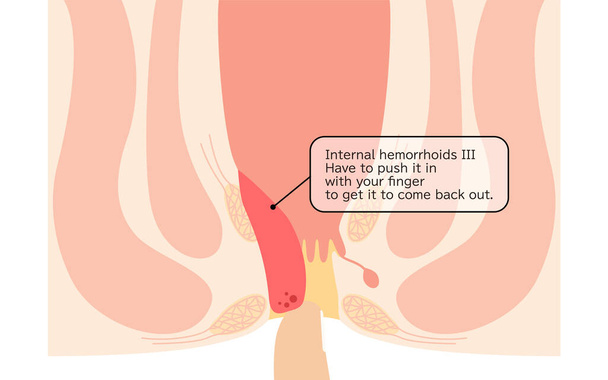 Diseases of the anus, hemorrhoids and warts "Internal hemorrhoids, degree III" Illustration, cross-sectional view - Translation: Internal hemorrhoids, degree III, You have to push it in with your finger to get it back - Vektor, Bild