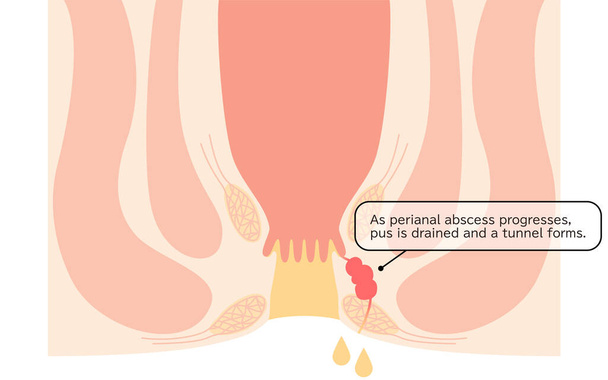 Diseases of the anus, hemorrhoids "Anorectal hemorrhoids" Illustration, cross-sectional view - Translation: Perianal abscess progresses, pus drains and tunnels form - Vektor, Bild