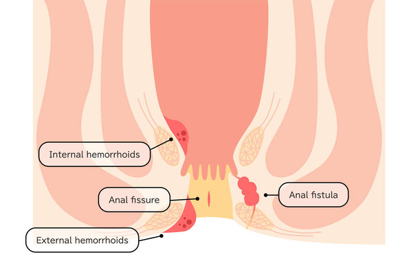 Diseases of the anus, hemorrhoids, warts, cut hemorrhoids, anorectal hemorrhoids Illustration, cross-sectional view - Translation: hemorrhoids, warts, cut hemorrhoids, anorectal hemorrhoids - Wektor, obraz