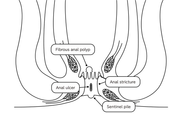 Diseases of the anus, hemorrhoids "anal ulcer, anal stenosis, anal polyp" Illustration, cross-sectional view - Translation: anal ulcer, anal stenosis, anal polyp, lookout warts - Wektor, obraz