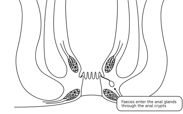 Diseases of the anus, hemorrhoids "Anorectal hemorrhoids" Illustration, cross-sectional view - Translation: Stool enters through the perineal fossa - Wektor, obraz