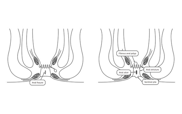 Diseases of the anus, hemorrhoids "anal hemorrhoid, anal ulcer, anal stenosis, anal polyp" Illustration, cross-sectional view - Translation: anal hemorrhoid, anal ulcer, anal stenosis, anal polyp - Vektör, Görsel