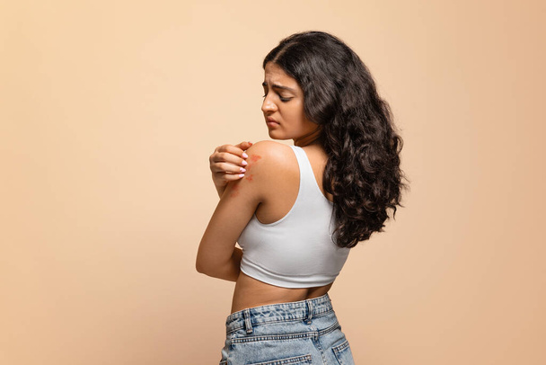 Ärtynyt nuori intialainen nainen raapi ärtynyttä ihoaan, järkytti itäistä naista, joka kärsii psoriaasista, ekseemasta tai dermatiitista, jolla on kutinaa ihottuma orvaskeden päällä, seisoo beige studion taustalla - Valokuva, kuva