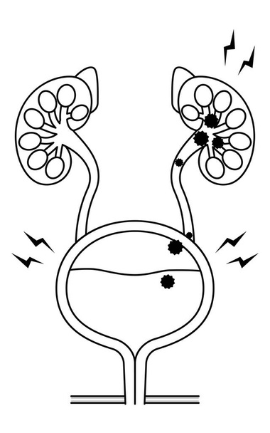 Медицинская иллюстрация пиелонефрита, обратный поток бактерий от мочевого пузыря к почкам, векторная иллюстрация - Вектор,изображение