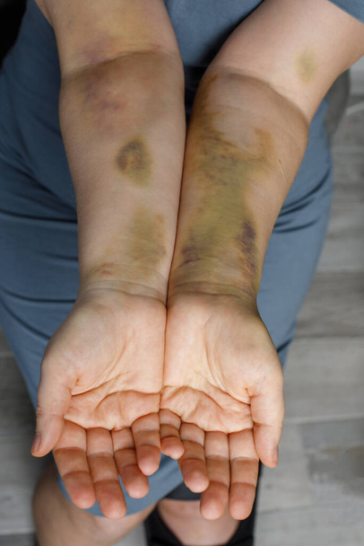 Žena ruka s autonehodou modřiny - Fotografie, Obrázek