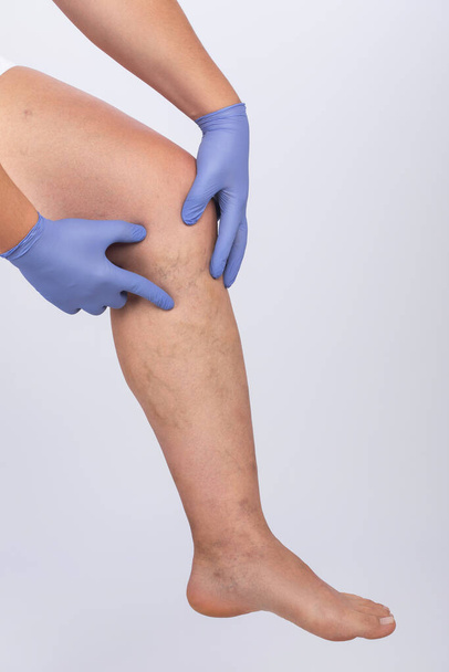 El hombre con guantes azules muestra la dilatación de pequeños vasos sanguíneos de la piel en la pierna. Inspección médica y tratamiento de Telangiectasia. Flebeurismo. - Foto, Imagen