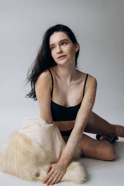 Kaunis tyttö, jolla on ongelma iho. Vitiligon hoito. Brunette alusvaatteita täpliä hänen ruumiinsa - Valokuva, kuva