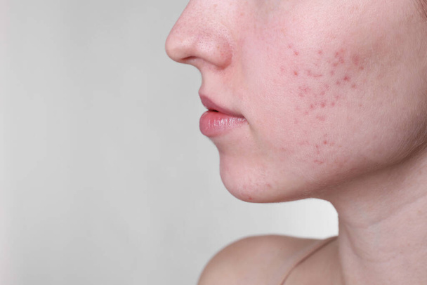 Young woman with acne problem on light grey background, closeup. Space for text - Foto, imagen