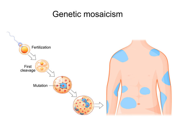 Mosaicismo genético. Mutación somática. Errores de replicación de ADN. Desarrollo celular desde la fertilización hasta la morula con mutación. Cuerpo humano con áreas afectadas. Edición somática del genoma. Ilustración vectorial - Vector, imagen
