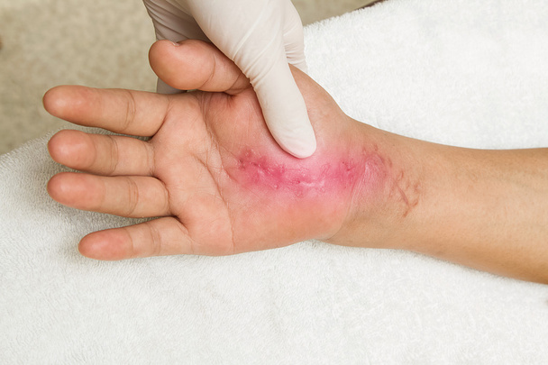 Cicatriz na mão. lesão da mão 6 semanas após a cirurgia
 - Foto, Imagem