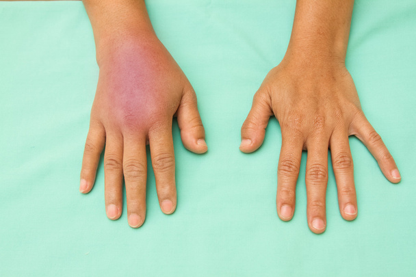 Las manos femeninas una hinchada e inflamada después del accidente
 - Foto, imagen