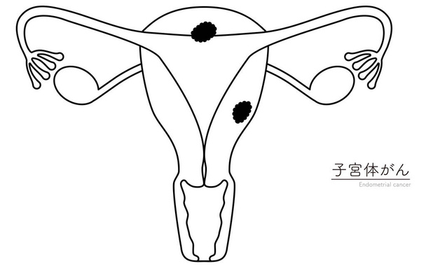 Ilustraciones ilustrativas del cáncer de endometrio, anatomía del útero y ovarios, ilustración vectorial - Vector, imagen