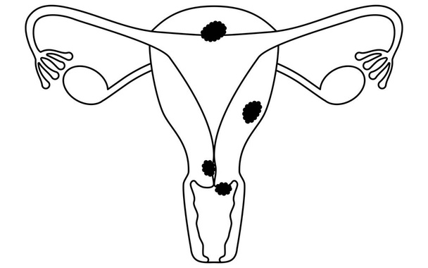 Διαγραμματική απεικόνιση του καρκίνου του τραχήλου της μήτρας, ανατομία της μήτρας και των ωοθηκών, διανυσματική απεικόνιση - Διάνυσμα, εικόνα