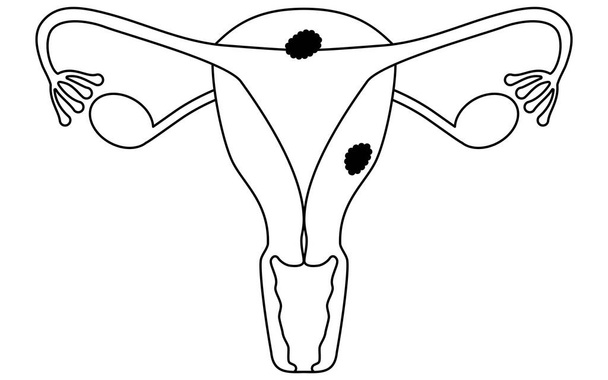 Ενδεικτικές απεικονίσεις του καρκίνου του ενδομητρίου, ανατομία της μήτρας και των ωοθηκών, διανυσματική απεικόνιση - Διάνυσμα, εικόνα