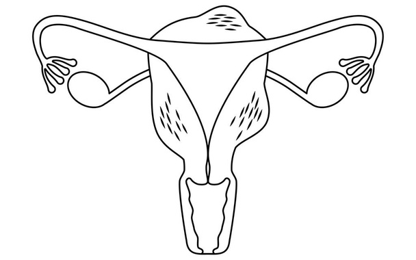 Adenomiyozun diyagramsal çizimi, rahim ve yumurtalıkların anatomisi, Vektör İllüstrasyonu - Vektör, Görsel