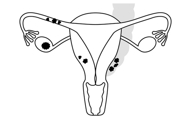 Ilustración diagramática del cáncer de ovario en estadio II, anatomía del útero y los ovarios, anatomía del útero y los ovarios - Traducción: El cáncer está presente en uno o ambos ovarios o trompas de Falopio y se diseminó hasta el útero y las trompas de Falopio en  - Vector, imagen