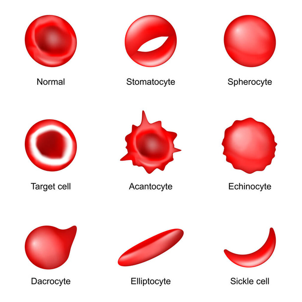 Forma de glóbulos rojos. drepanocitos, equinocitos, esferocitos, eliptocitos, acantocitos, estomatocitos, dacrocitos, células diana y eritrocitos normales. Poikilocitosis. Enfermedades sanguíneas. Ilustración vectorial - Vector, Imagen