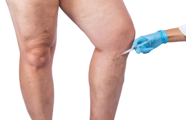 Rimozione delle vene varicose sulle gambe. Ispezione medica e trattamento della telangiectasia. Flebeurisma. - Foto, immagini