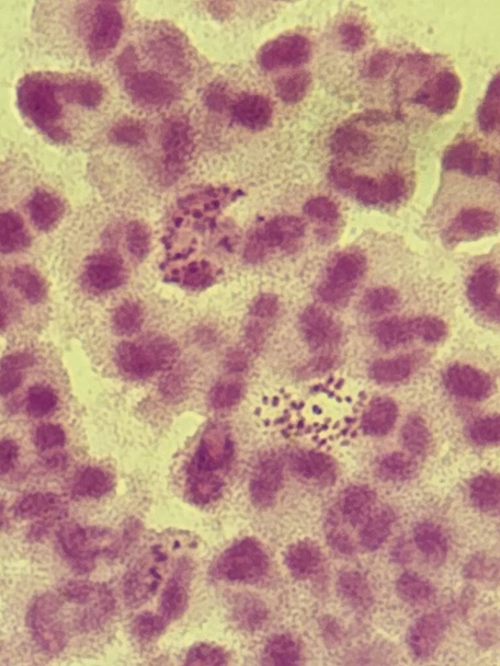 Neisseria gonorrhea on Gram stain - intracellular Gram negative diplococci - Photo, Image