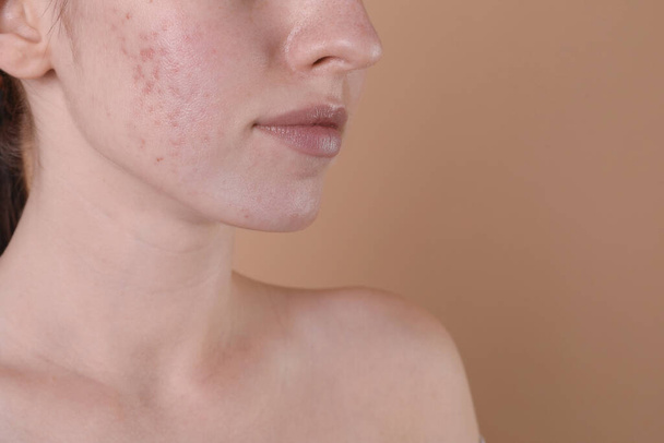 Young woman with acne problem on beige background, closeup. Space for text - Foto, imagen