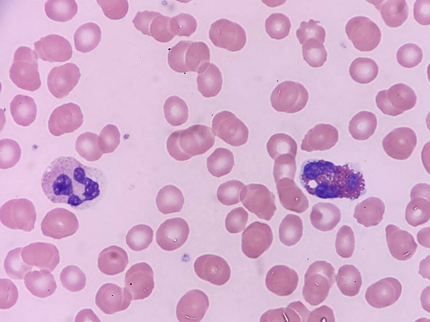 Eosinófilo e neutrófilo no esfregaço de sangue periférico - Foto, Imagem