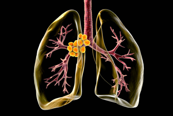 Monimutkainen 3D-kuva paljastaa mediastinaalinen lymfadeniitti sisällä läpinäkyvä ihmisen keuhkoihin. - Valokuva, kuva