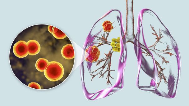 Keuhkojen blastomykoosi, johon liittyy keuhkomuutoksia ja keuhkoputkien imusolmukkeiden suurenemista, ja lähikuva sienestä Blastomyces dermatitidis, 3D-kuva. - Valokuva, kuva