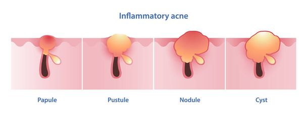 Diagram of inflammatory acne types vector illustration isolated on white background. Papule, pustule, nodule, nodular, nodulocystic, cystic acne and cyst. Skin care and beauty concept. - Vector, Image