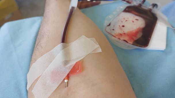 βραχίονας του εθελοντή δότη κατά τη διάρκεια αιμοδοσίας με τη βελόνα κολλημένη στο βραχίονα - Φωτογραφία, εικόνα