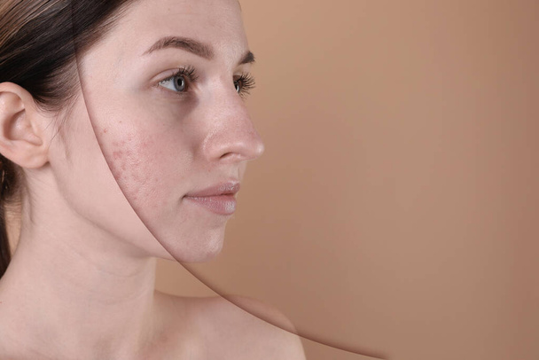 Acne problem, collage. Woman before and after treatment on beige background, space for text - Photo, image