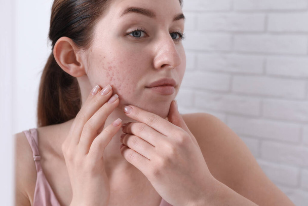 Woman with acne problem near mirror indoors - Фото, зображення