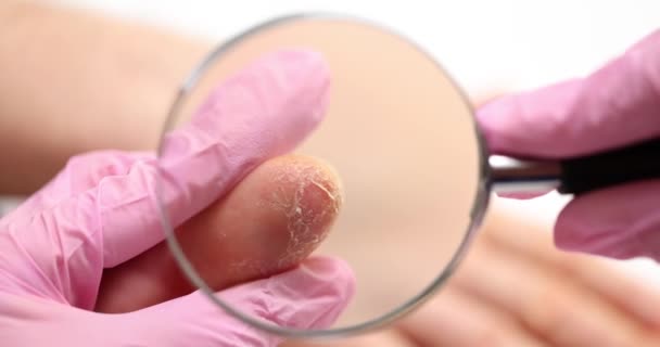 Médecin en gants roses examine ongles et la peau des mains du patient à l'aide d'une loupe. Patient malade avec peau sèche et fissurée des mains - Séquence, vidéo