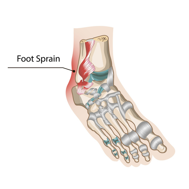 Foot Sprain - Vector, Image