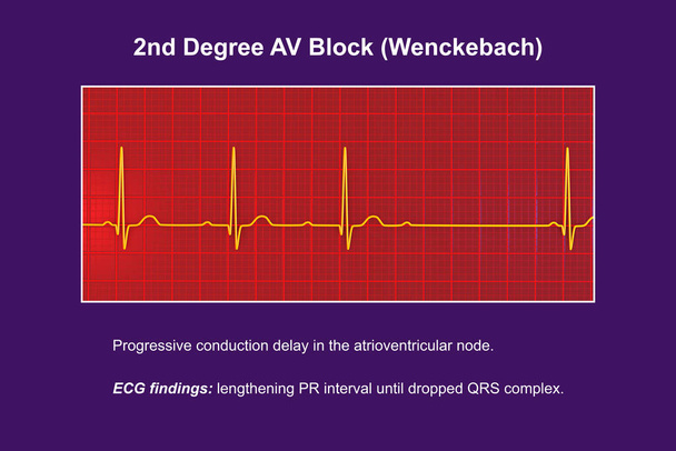 3D illustratie visualiseren van een ECG van 2e graad AV blok (Wenckebach), met de nadruk op abnormale elektrische geleiding in het hartritme. - Foto, afbeelding