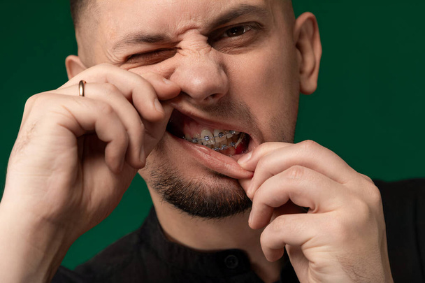 Egy férfi fogszabályzóval a fogán egy vicces arckifejezésbe torzítja az arcát, bemutatja a fogászati munkáját, ahogy viccelődik és szórakoztatja a körülötte lévőket.. - Fotó, kép